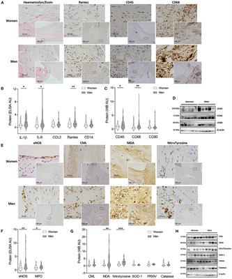 Sex-Differences in Aortic Stenosis: Mechanistic Insights and Clinical Implications